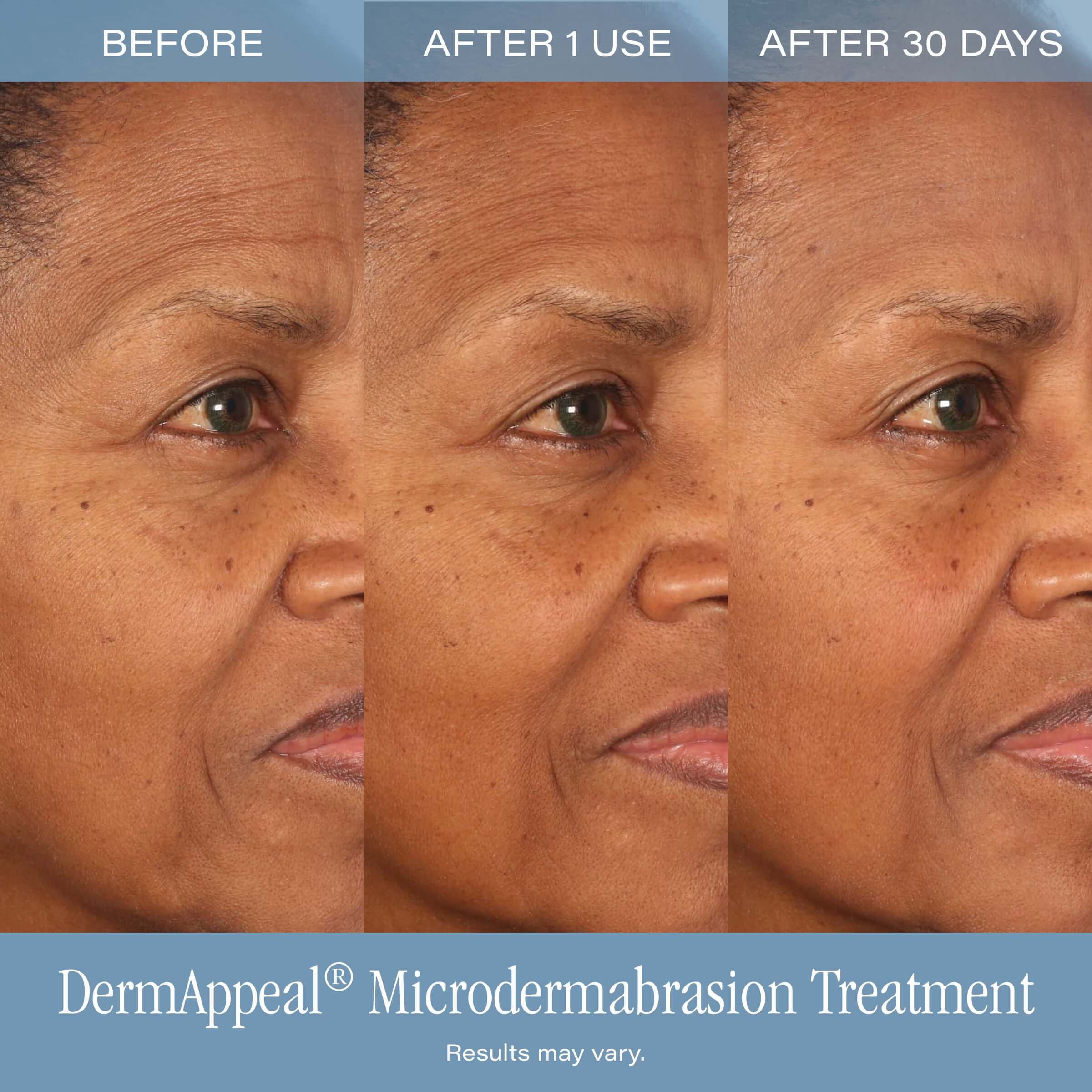 DermAppeal® Microdermabrasion Treatment - Image 5