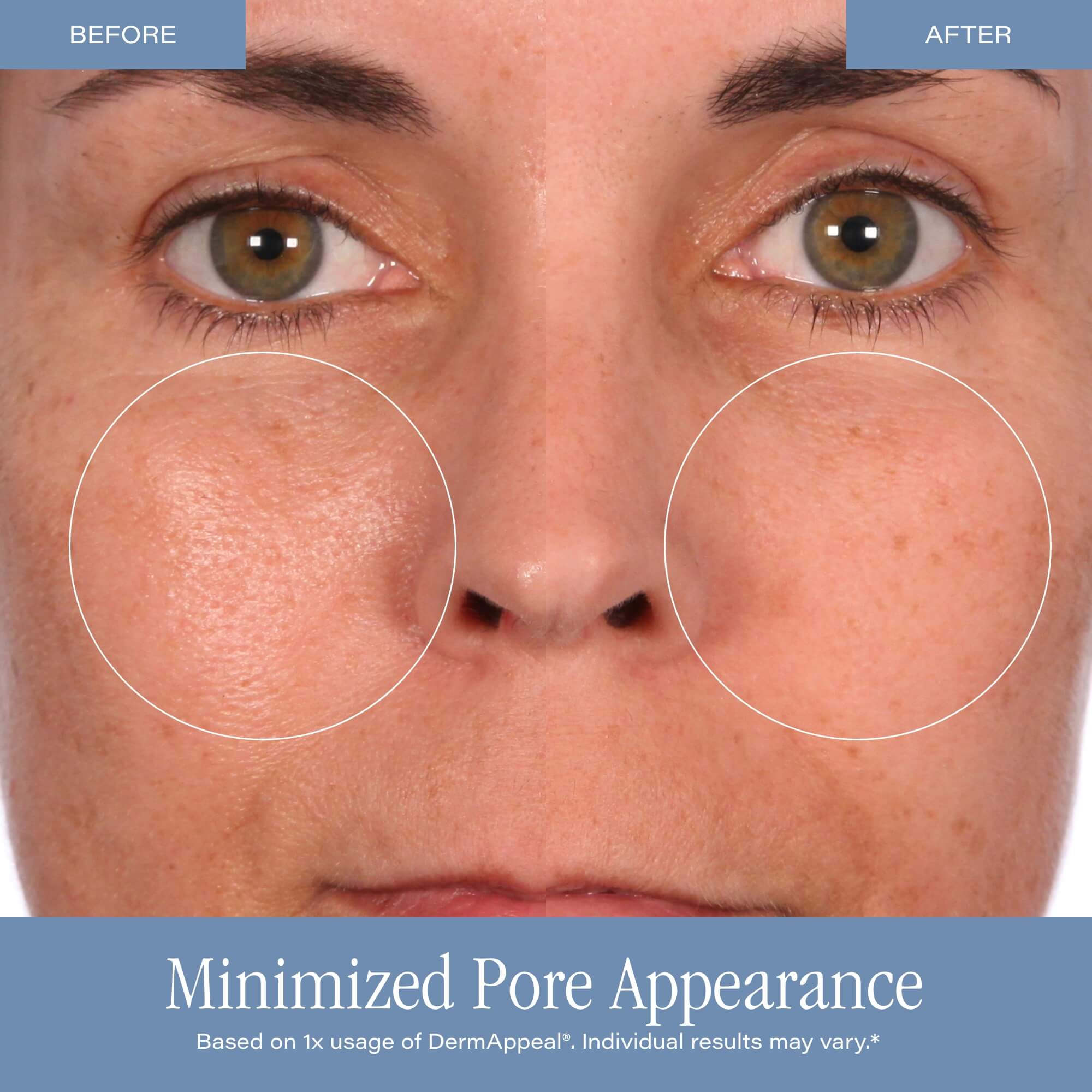 DermAppeal® Microdermabrasion Treatment - Image 11